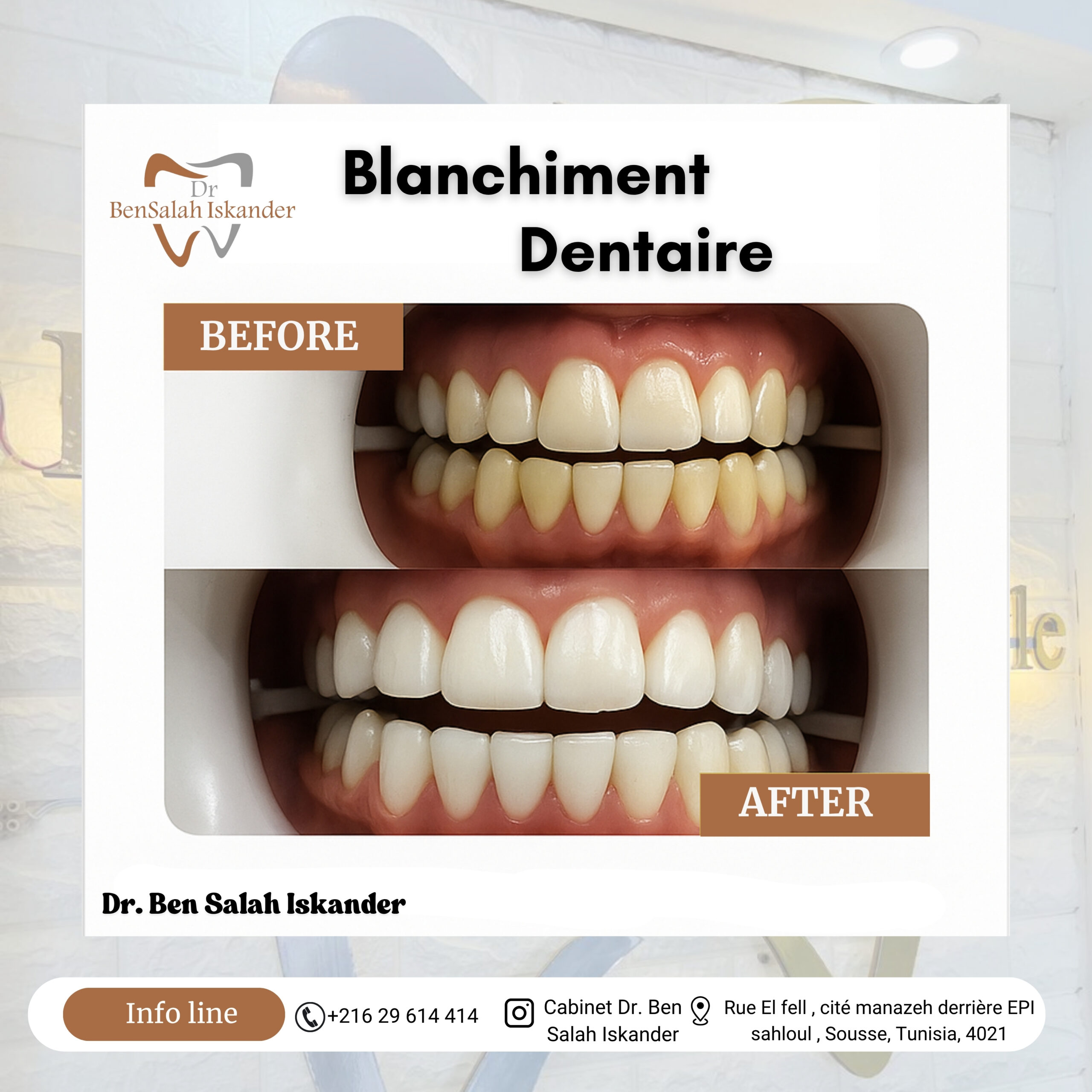 Blanchement Dentaire