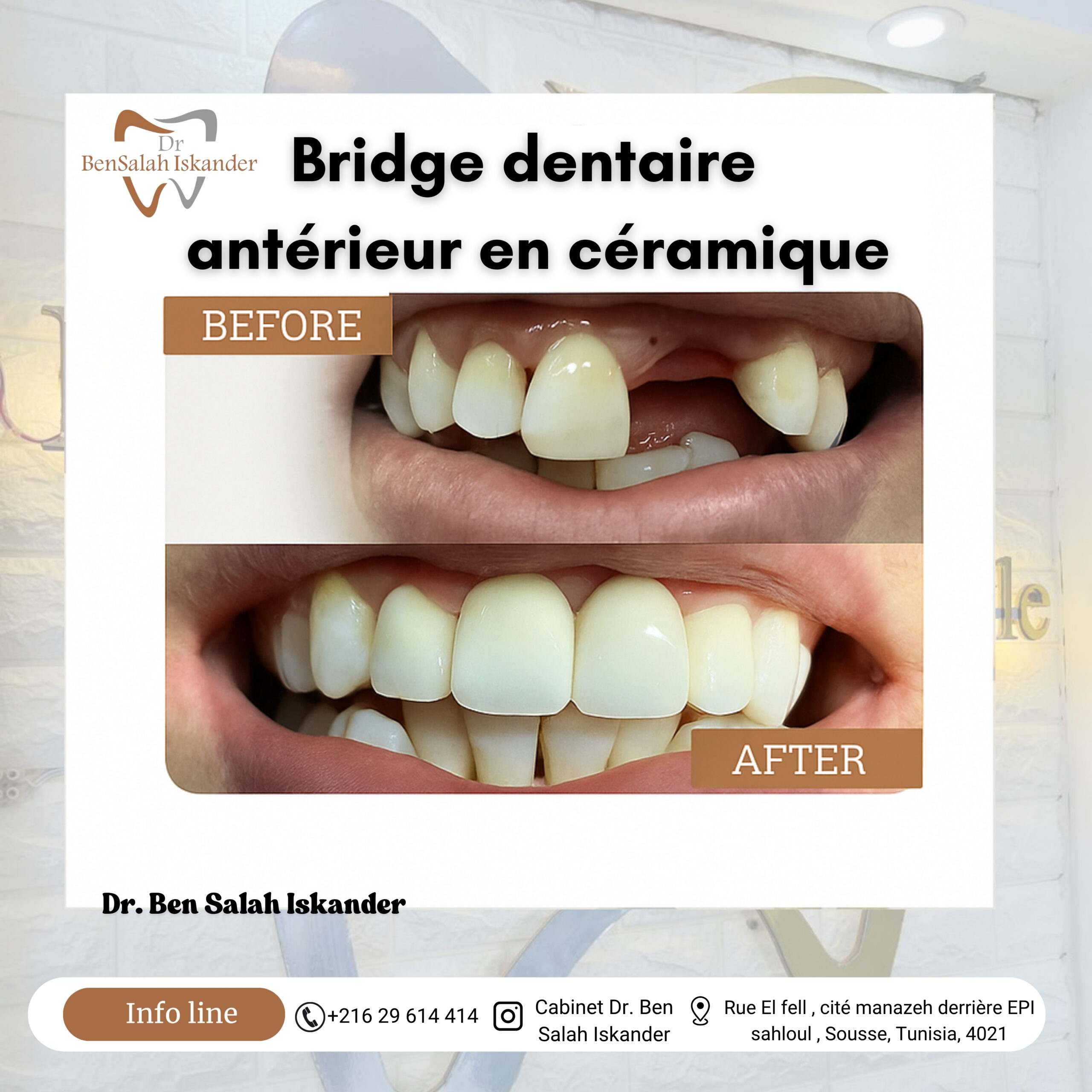 Bridge dentaire abtérieur en céramique