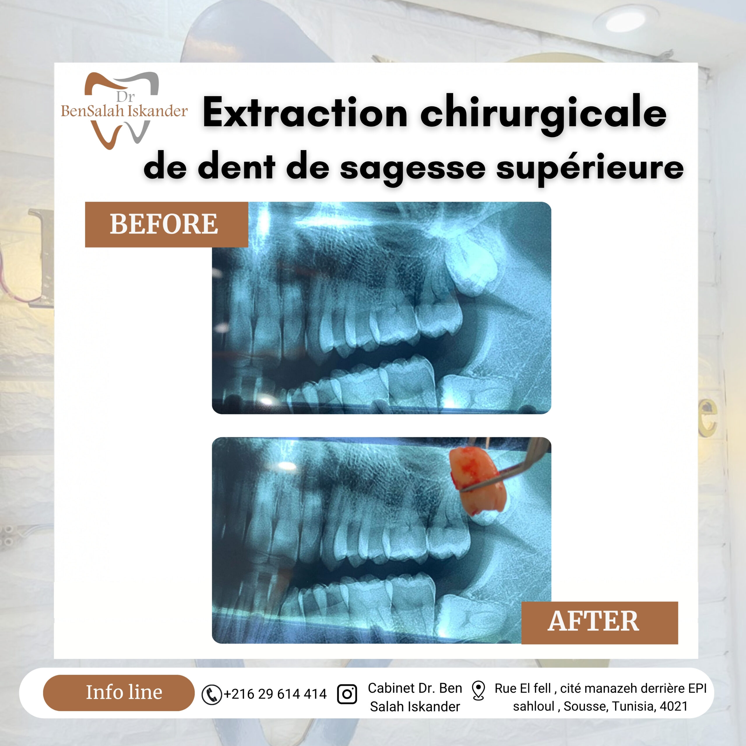 Extraction chirurgicale de dent de sagesse supérieur