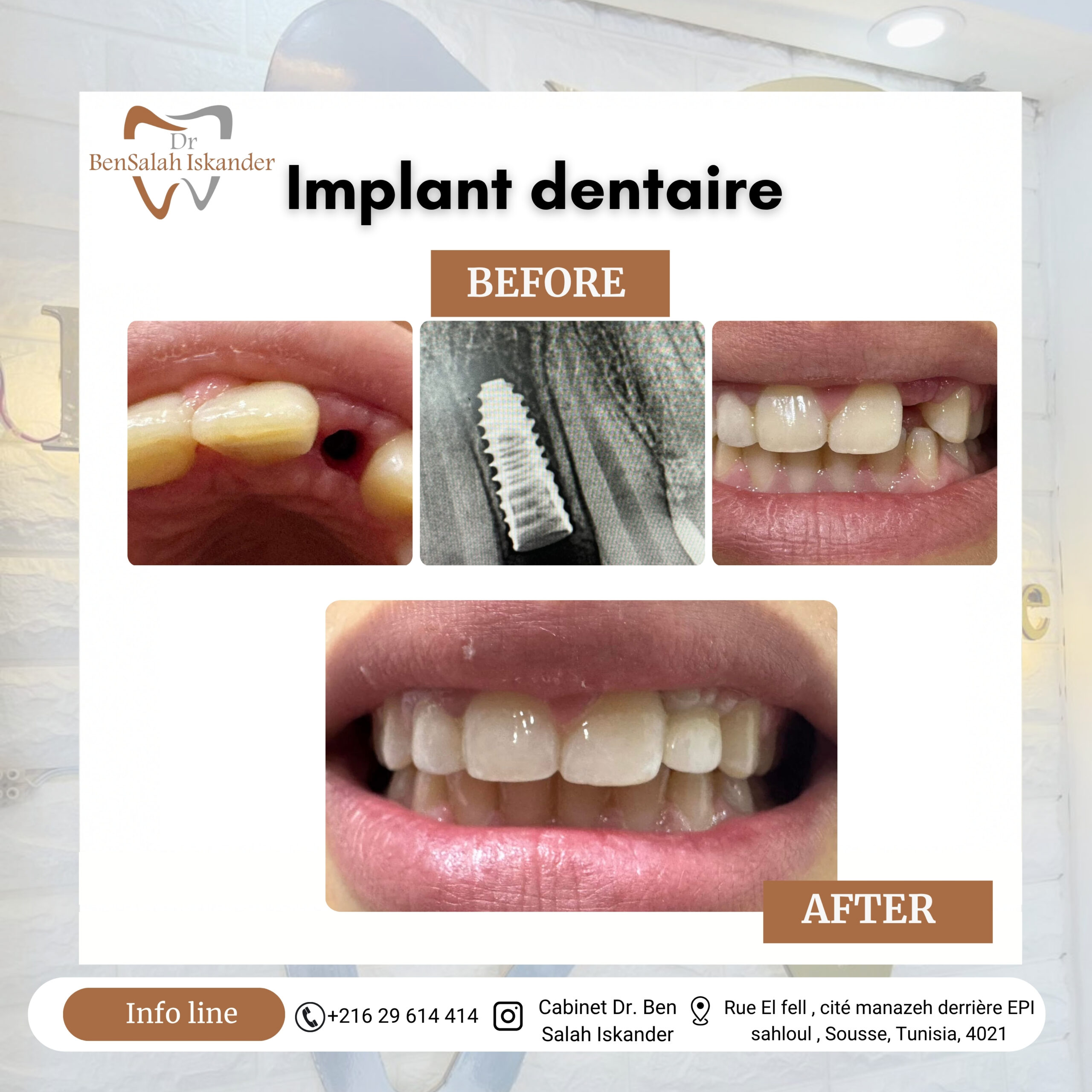 Implant dentaire
