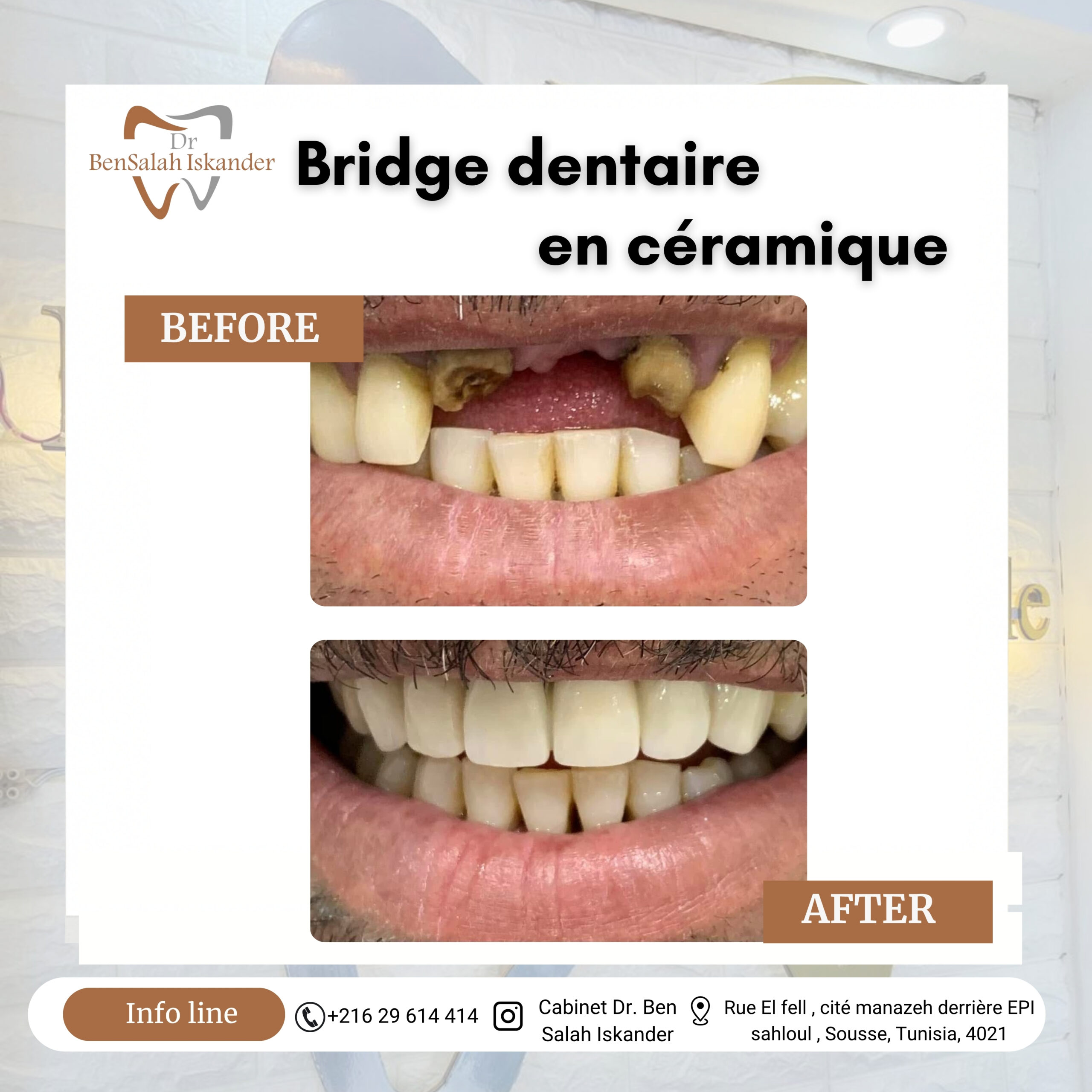 Bridge dentaire en céramique