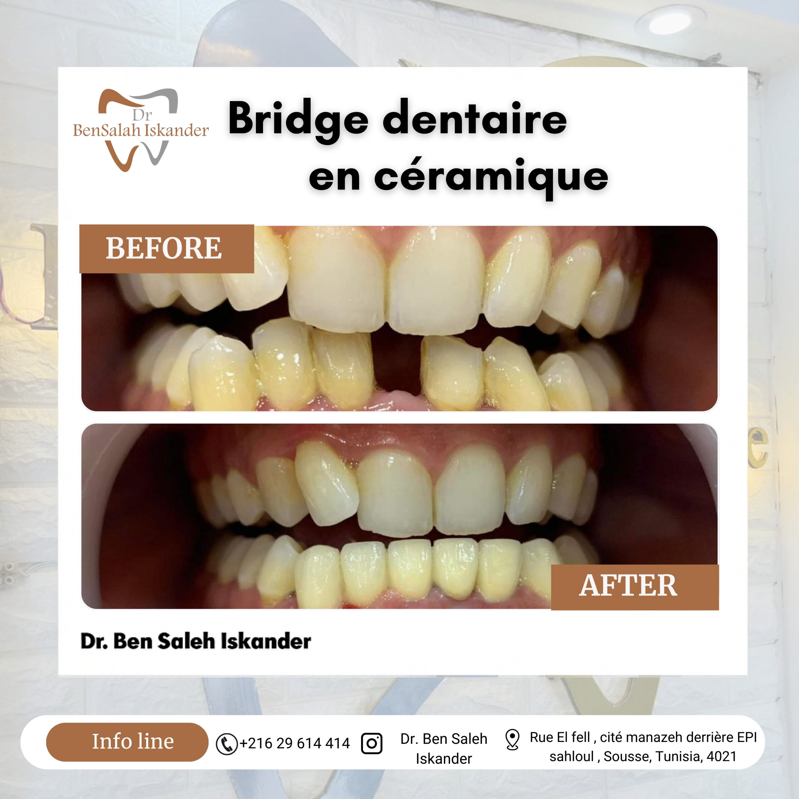 Bridge dentaire en céramique