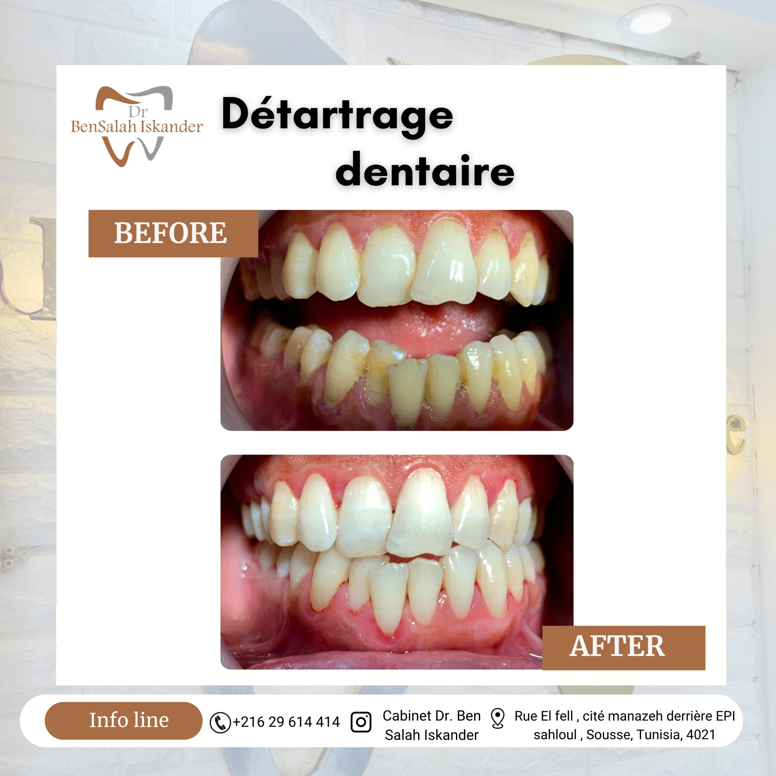 Détartrage dentaire